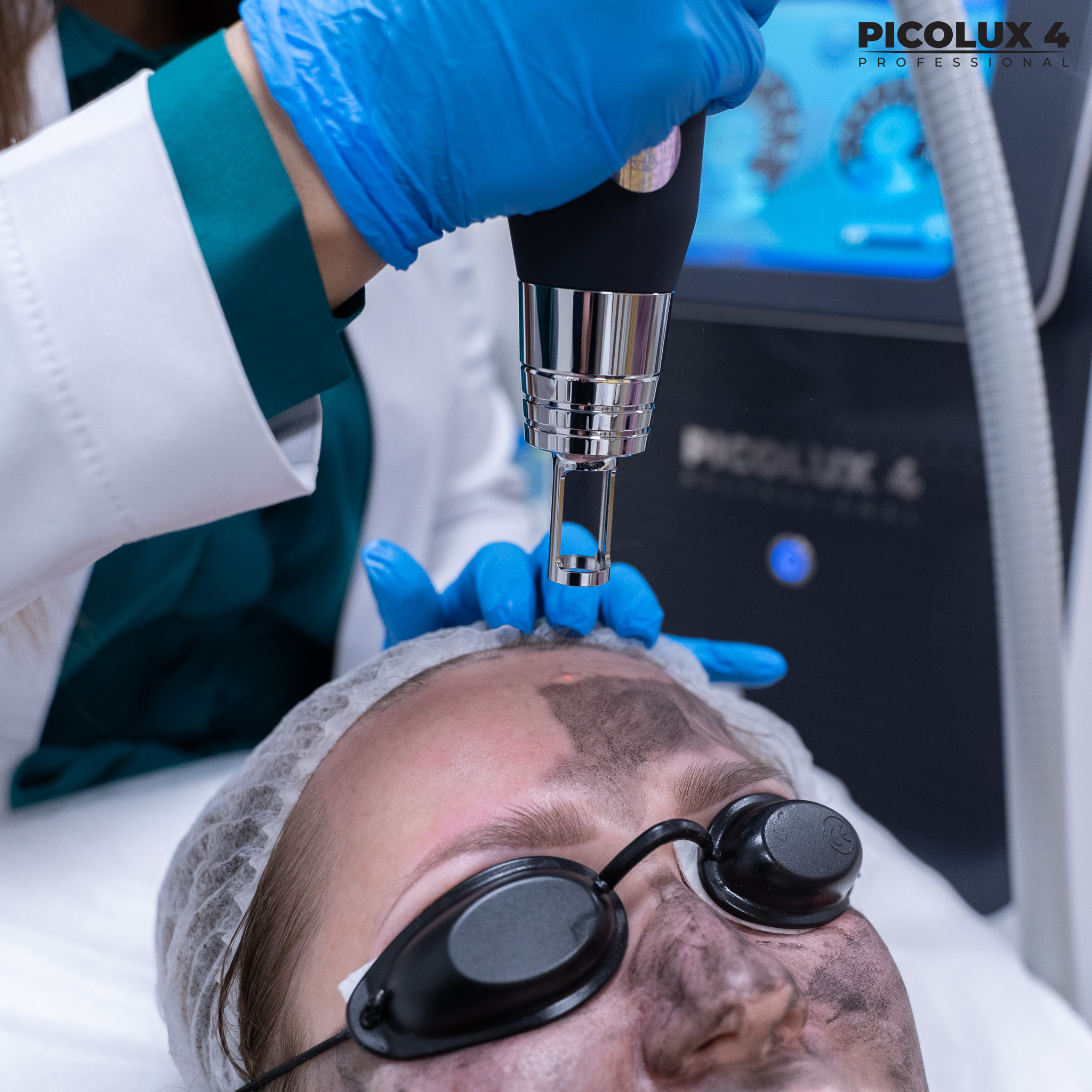 Zabiegi laserowego peelingu węglowego mogą być wykonywane na całym ciele.