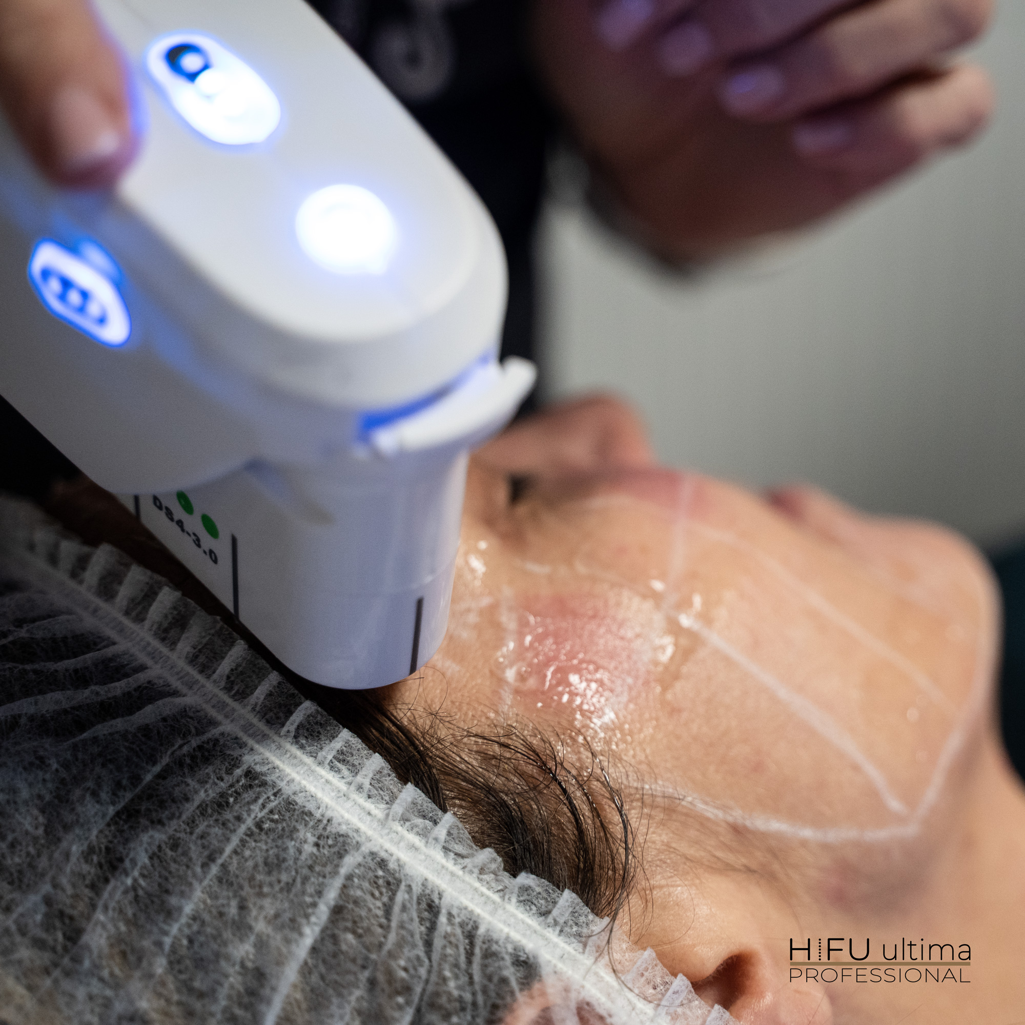 Technologia HIFU gwarantuje efekty, które utrzymują się do ponownego zestarzenia skóry