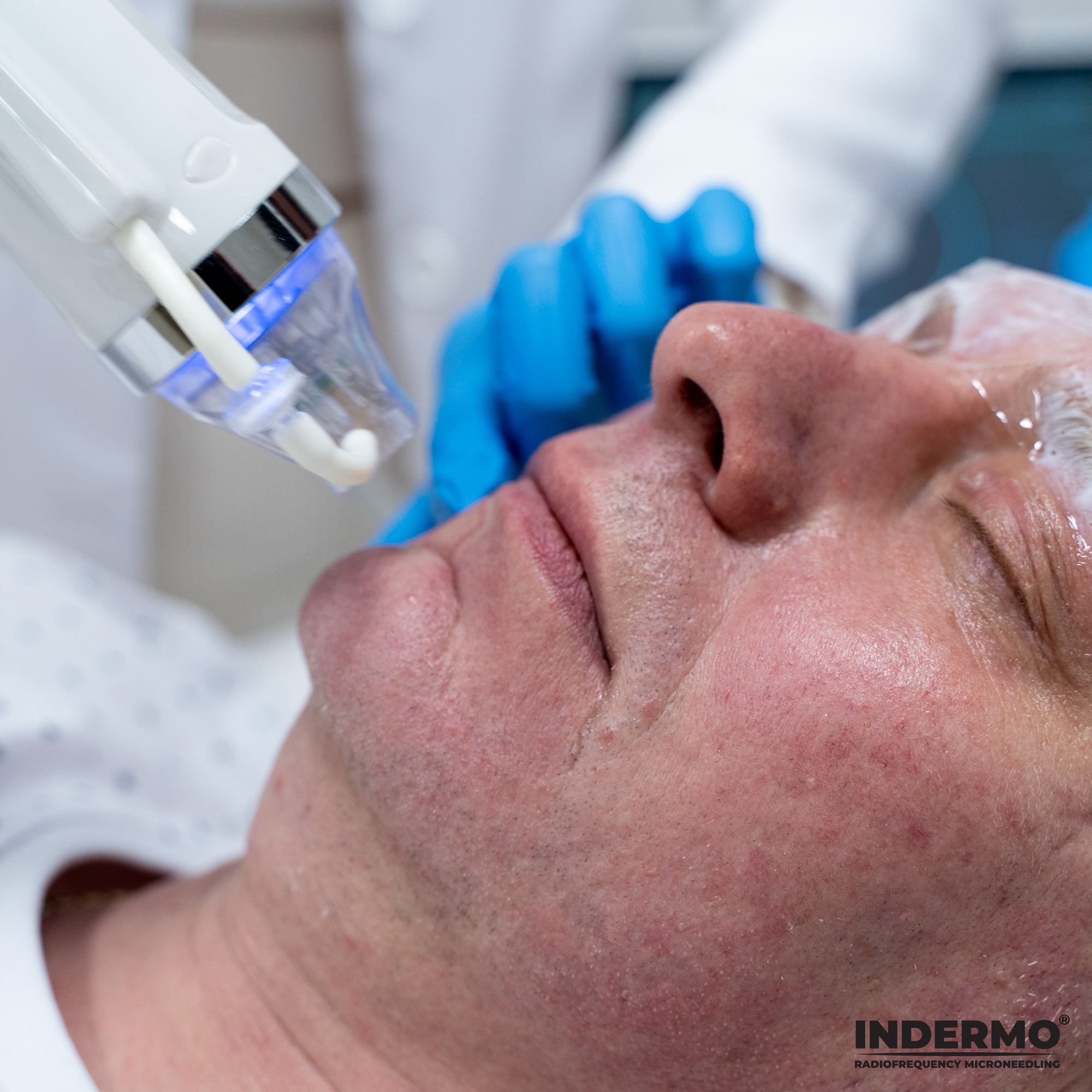 Podczas terapii RF nie ma ryzyka poparzenia skóry na twarzy