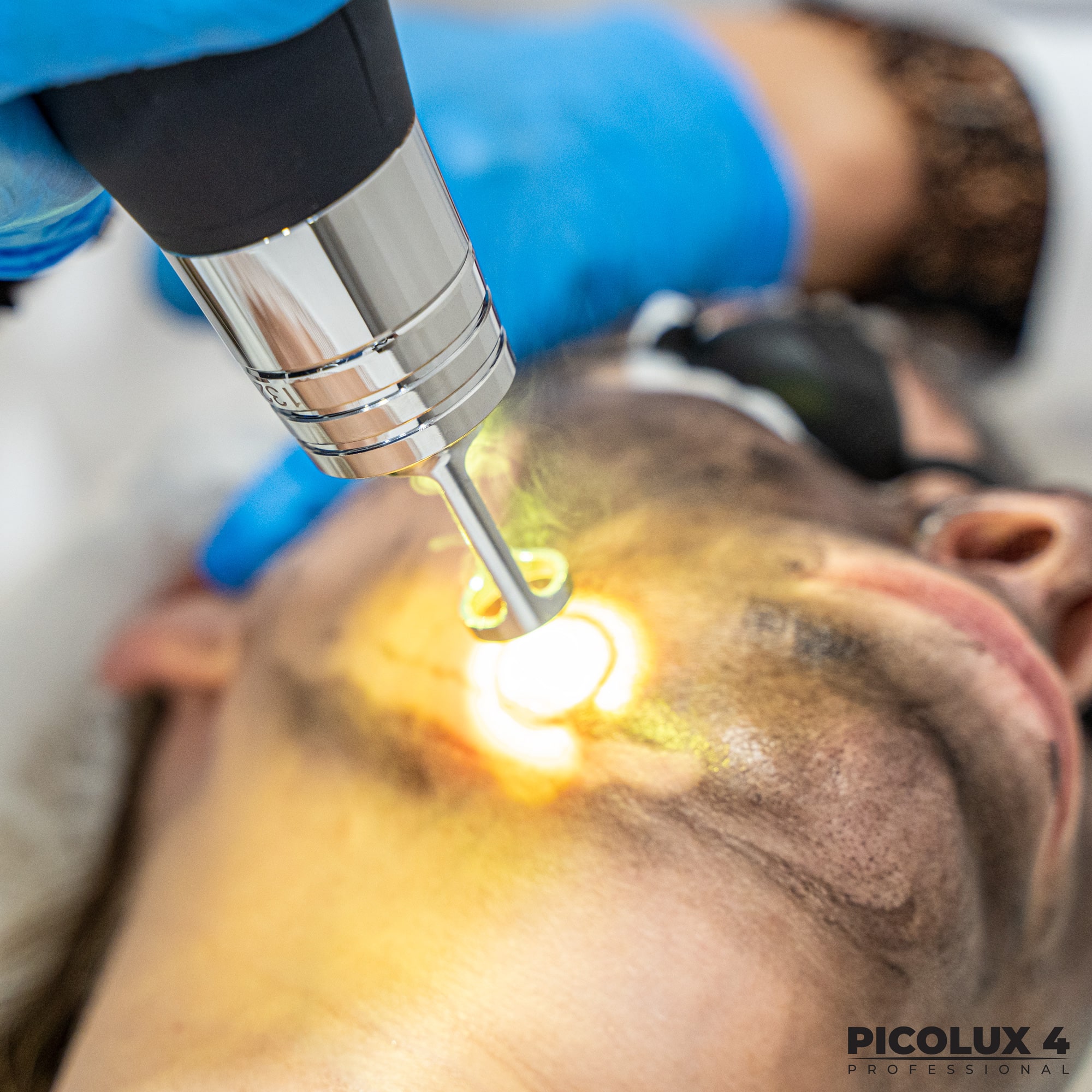 Laserowy peeling węglowy wspomaga usunąć zmiany pigmentacyjne na twarzy