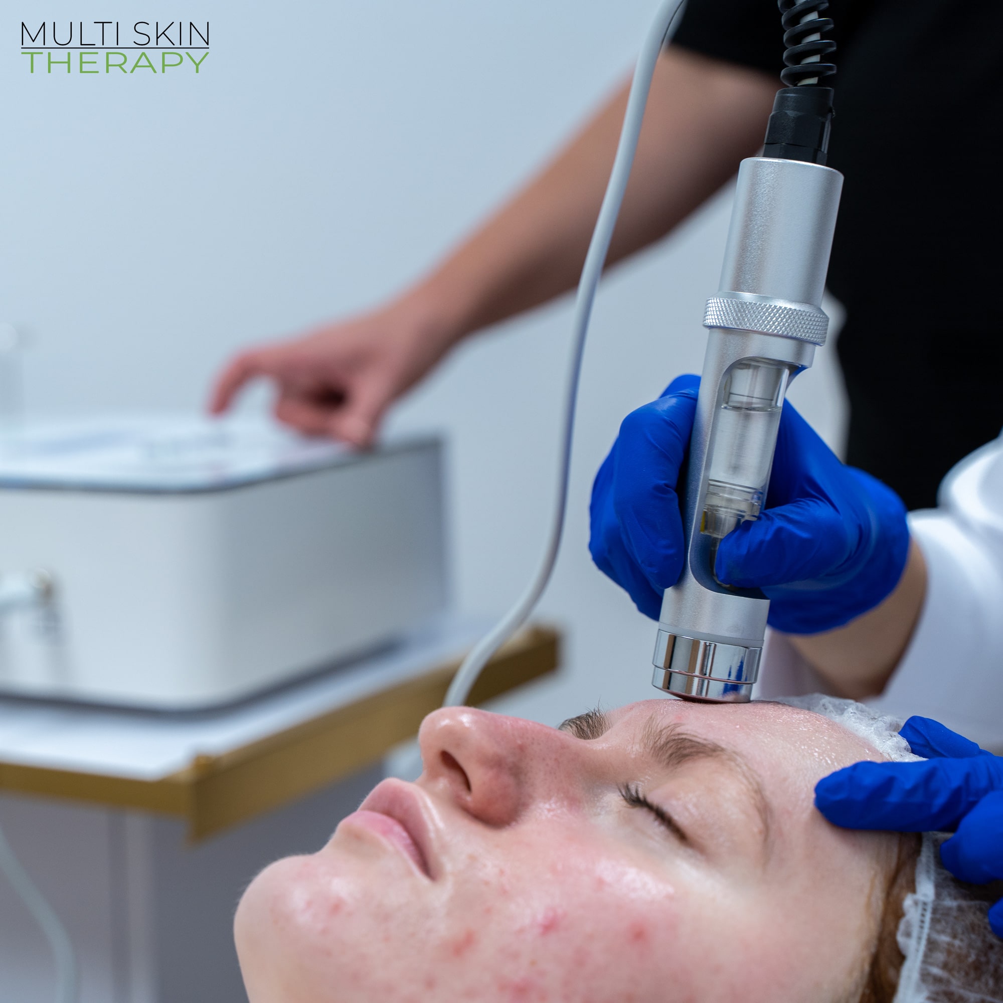 Mezoterapia bezigłowa wykorzystuje technologię elektroporacji w zabiegach na twarz