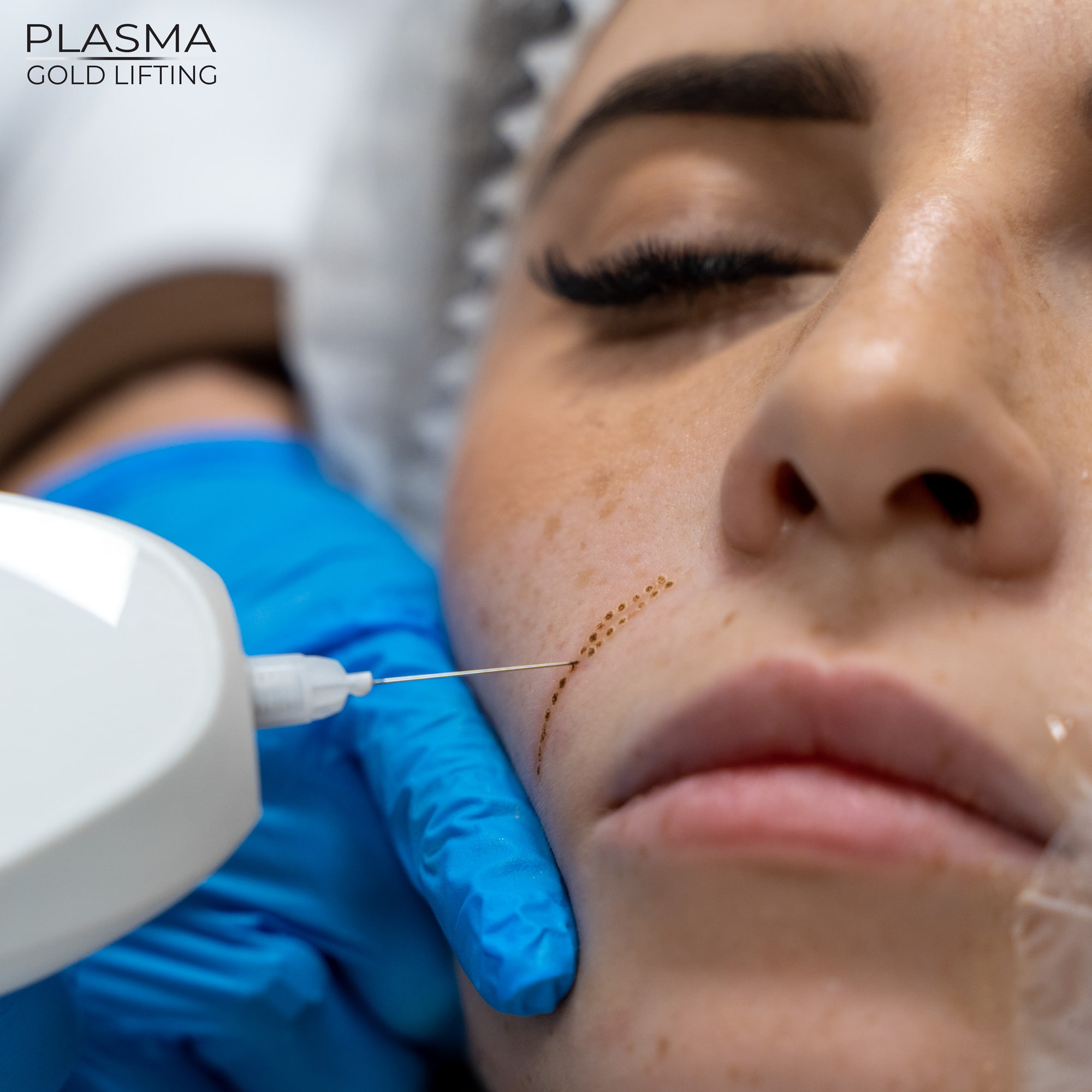 Plazma azotowa znajduje zastosowanie w ujędrnianiu twarzy, szyi i dekoltu