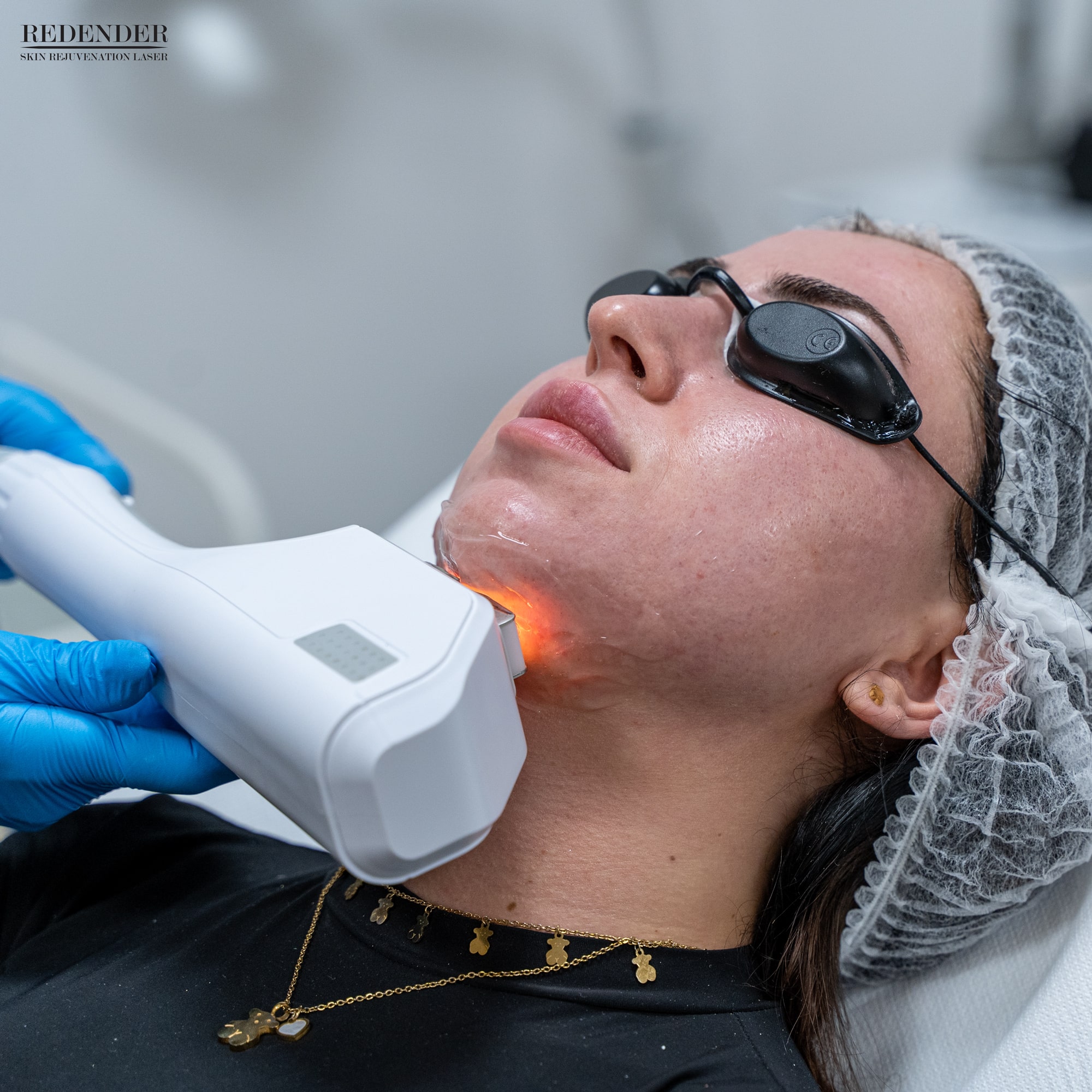 Laserowe odmładzanie skóry można wykonać na obszarze twarzy, szyi, dekoltu i dłoniach